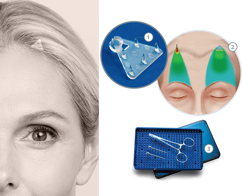 browlifts-preface-cosmetic-endoscopic