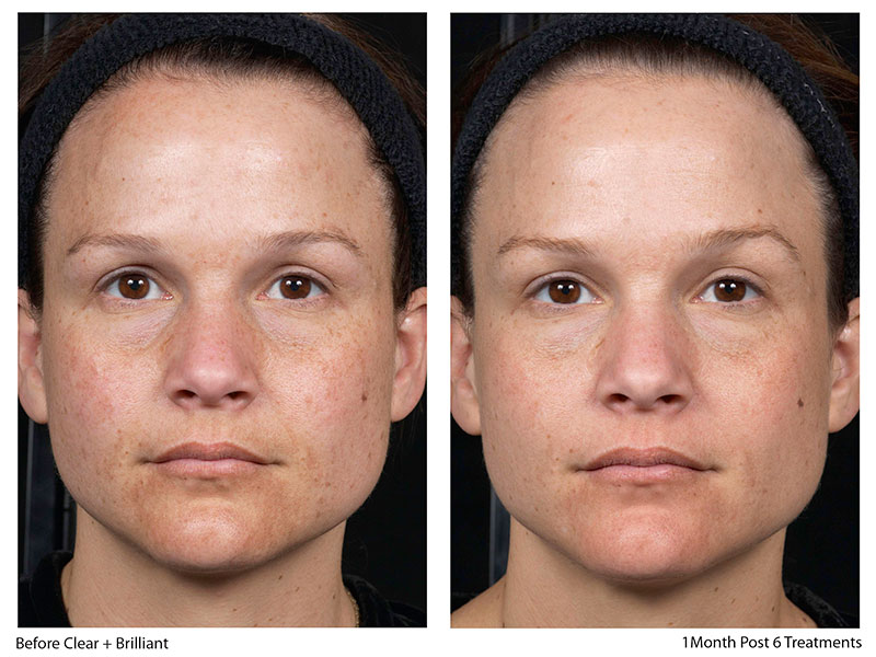 before-and-after-clear-brilliant-newcastle before and after results Clear + Brilliant