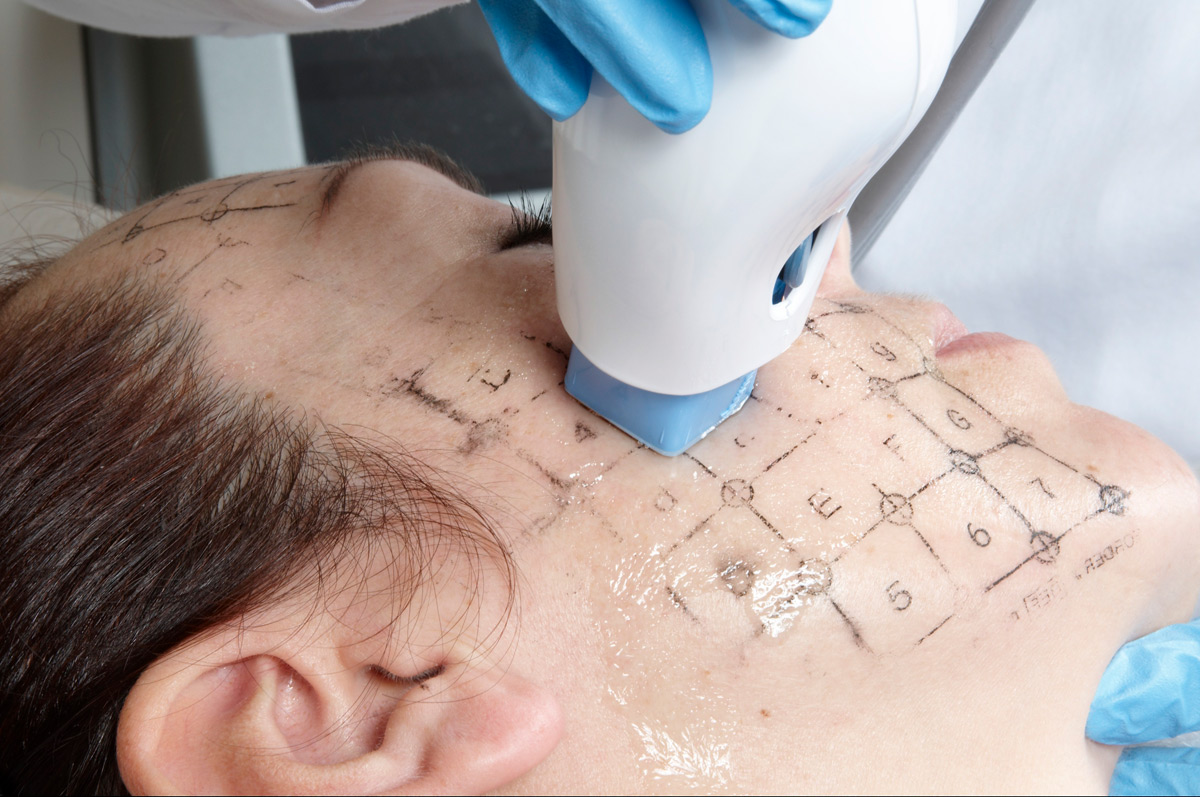 Thermage facial treatment newcastle nsw preface cosmetic