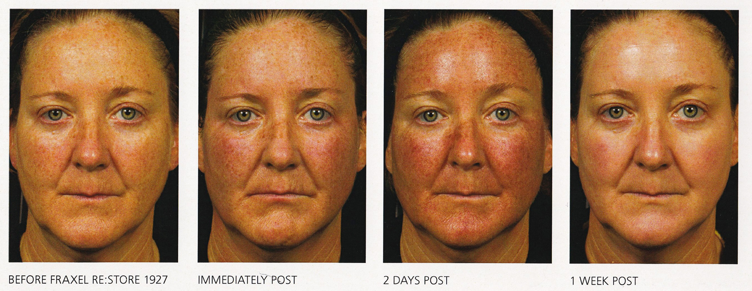 Fraxel Restore One Week Post