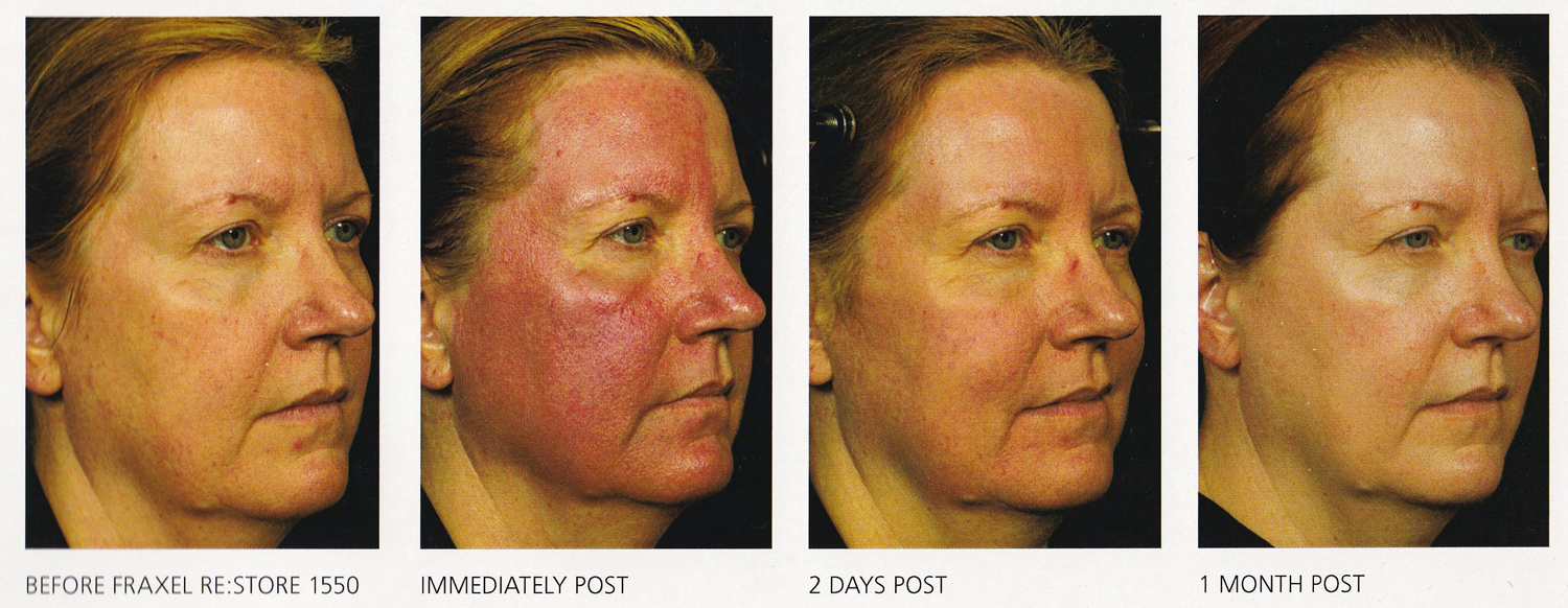 Fraxel Restore B & A