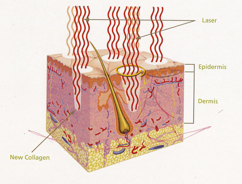 Fraxel Dual Collagen Newcastle