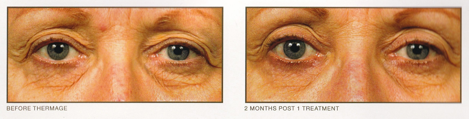 Thermage Eye Post Treatment
