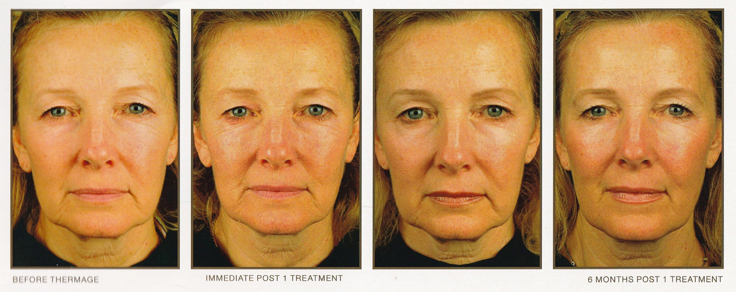 Thermage Results Over Time