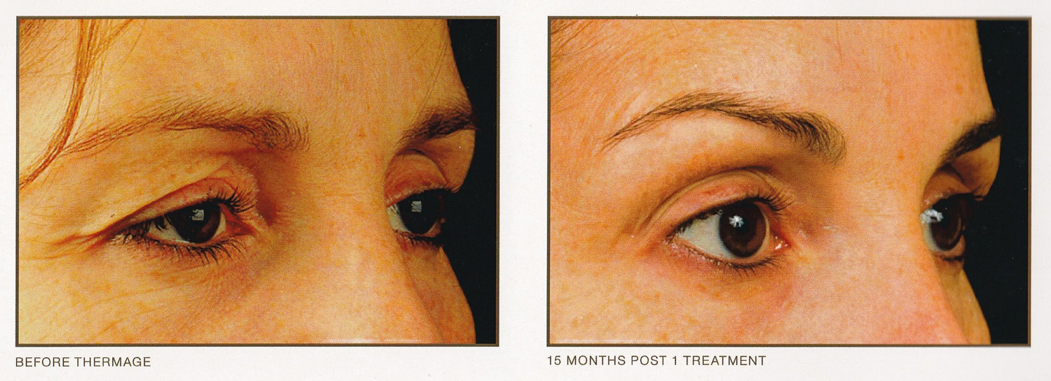 Thermage 1 Week Post Treatment