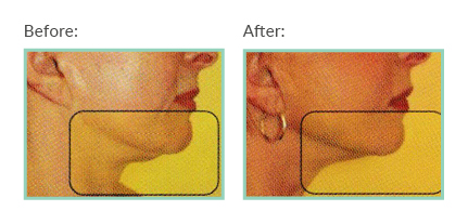 areas that can be treated iNeedle Chin Threadlift Newcastle