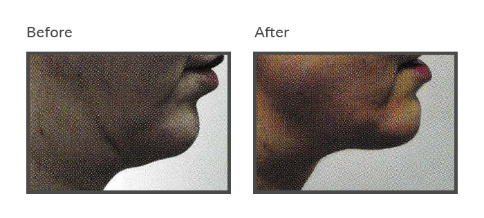 before and after iNeedle Chin Threadlift Newcastle