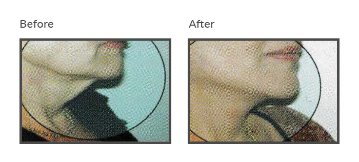 before and after iNeedle Chin Threadlift Newcastle3
