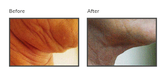 before and after iNeedle Chin Threadlift Newcastle4