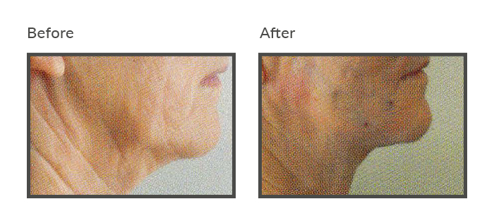 before and after iNeedle Chin Threadlift Newcastle5