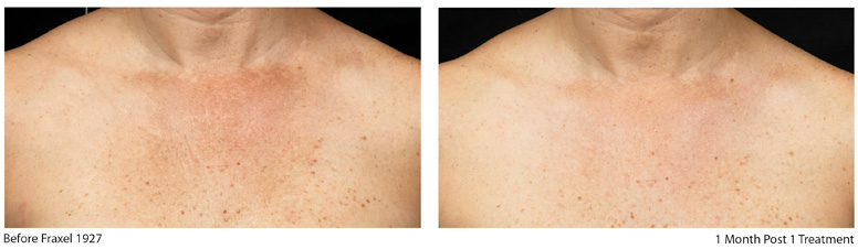 fraxel restore 1927 for necks