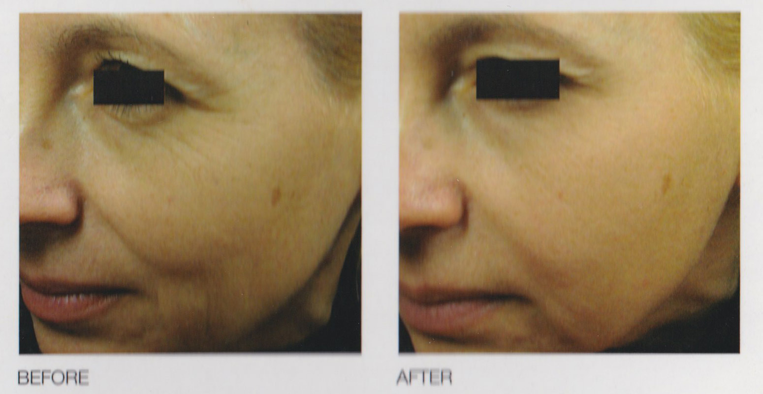 eTwo-Sublime-results-Preface-Cosmetic-NewcastleNSW