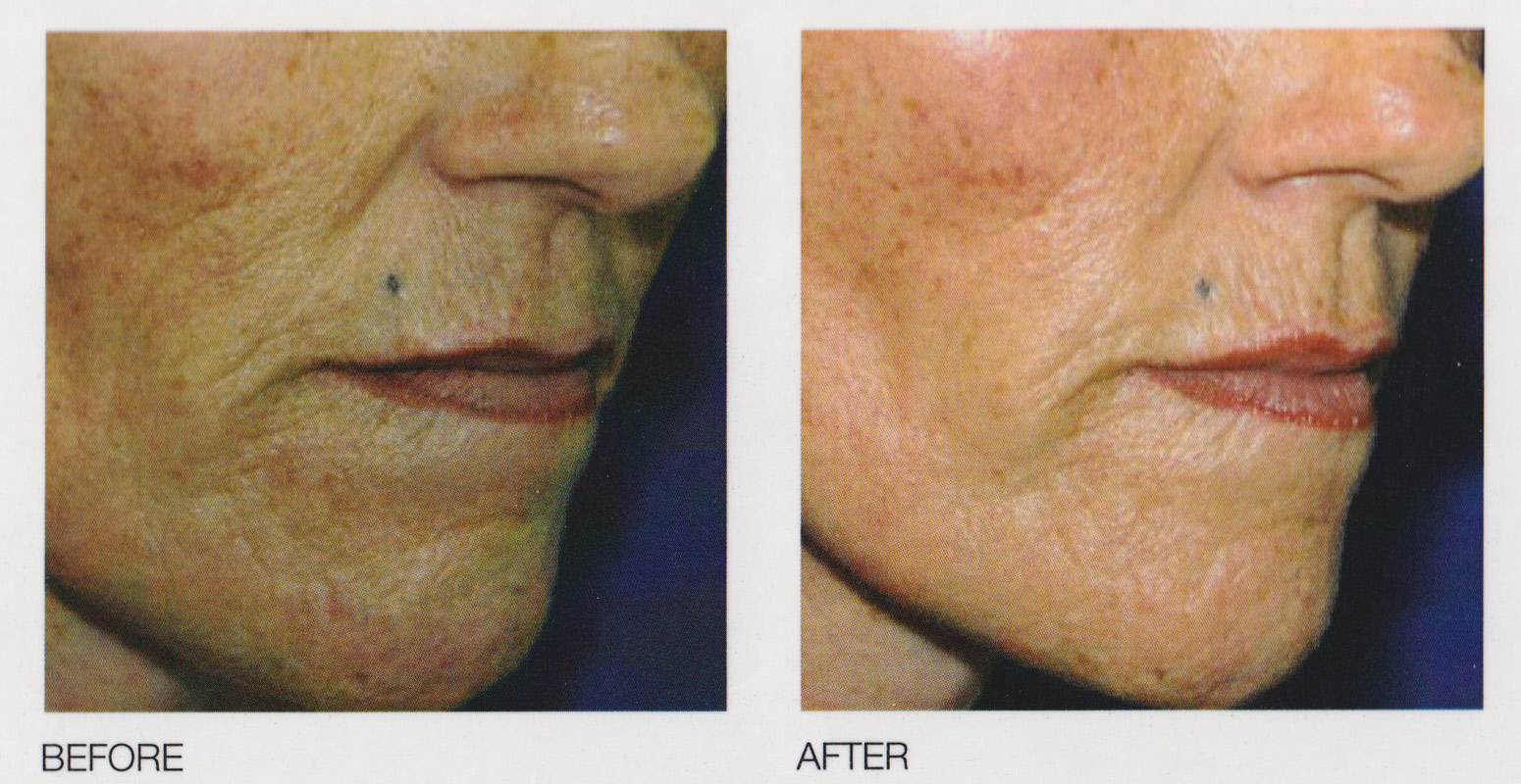 eTwo-Sublime-treatment-Preface-Cosmetic-NewcastleNSW
