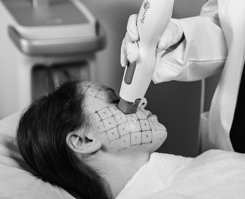 Thermage-facial-treatment-newcastle-nsw-preface-cosmetic- Thermage Facial Treatment Newcastle NSW