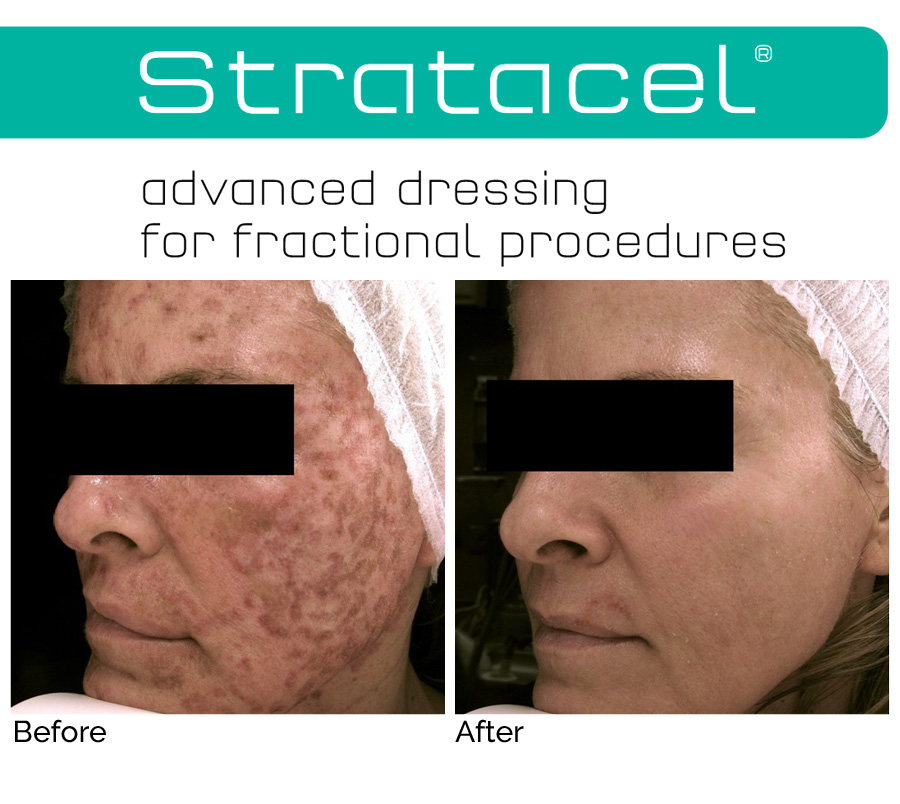 About-Stratacel-post-operative-skin-care-at-preface-cosmetic-newcastle-nsw2
