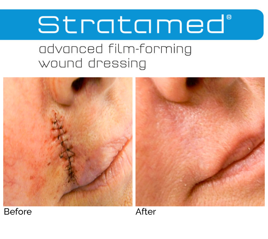 About-Stratamed-post-operative-skin-care-at-preface-cosmetic-newcastle-nsw2