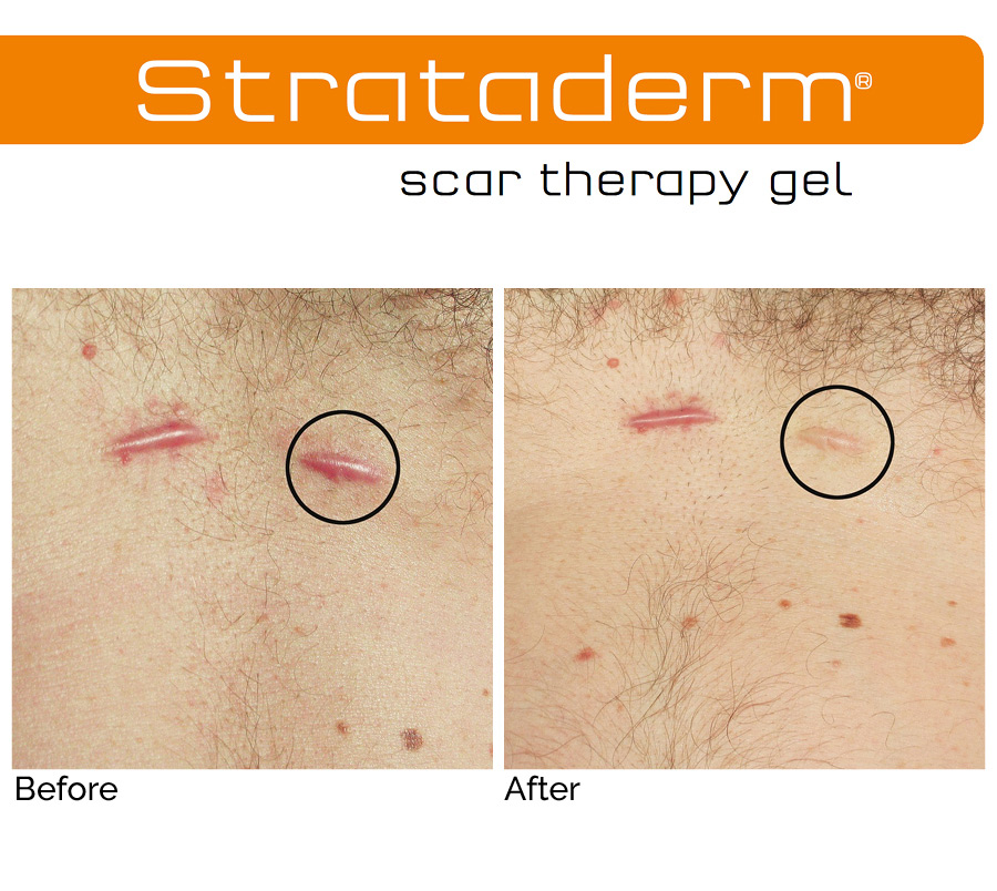 Before-After-Strataderm-post-operative-skin-care-at-preface-cosmetic-newcastle-nsw