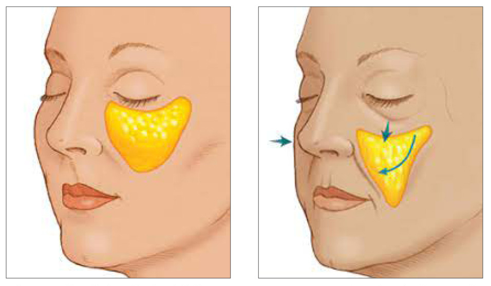 Preface Cosmetic Cheek Lifting Procedures