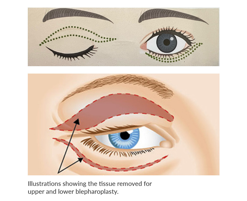 Blepharoplasty surgery (upper and lower eyelid surgery)