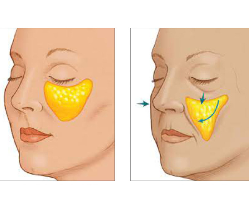 Cheek Lifting Surgery