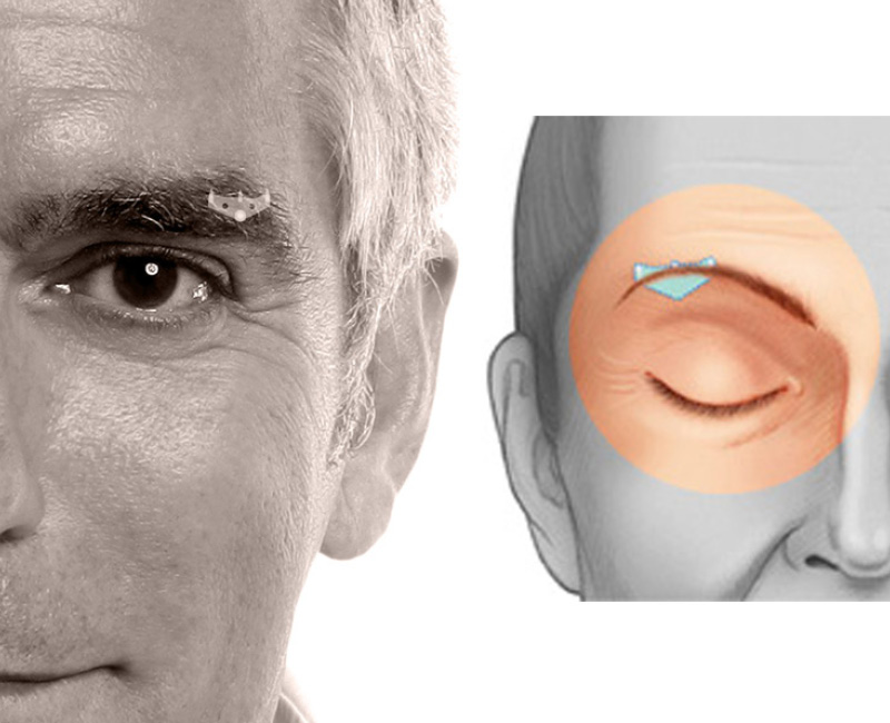 Eyebrow lifting surgery