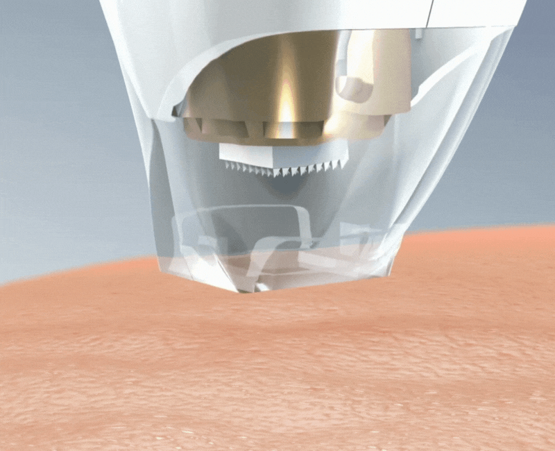 Tixel Treatment