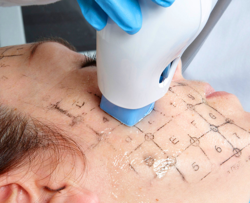 Thermage RF