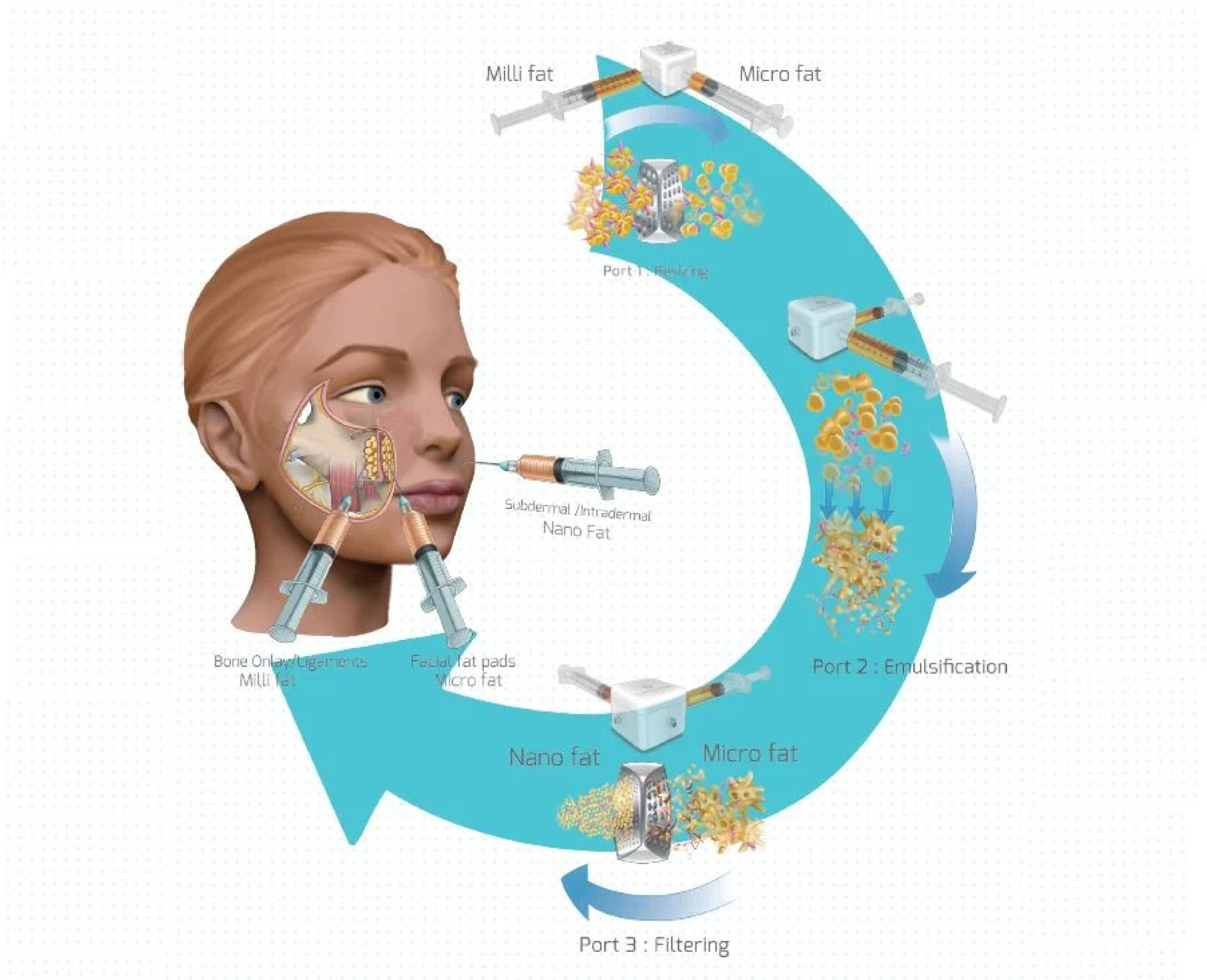 Lipofilling Fat Transfer Lipofilling Fat Transfer