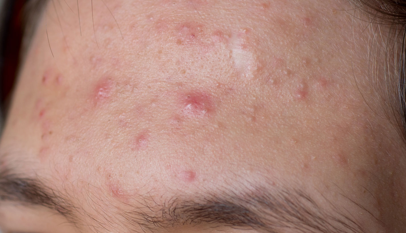 Acne forehead