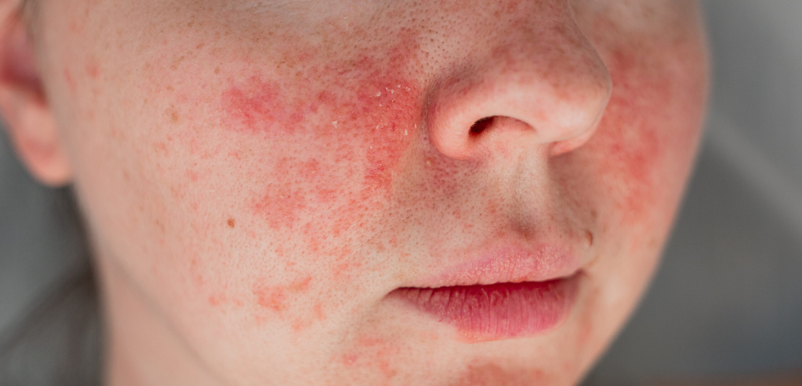 Textures Red Skin on cheeks of woman