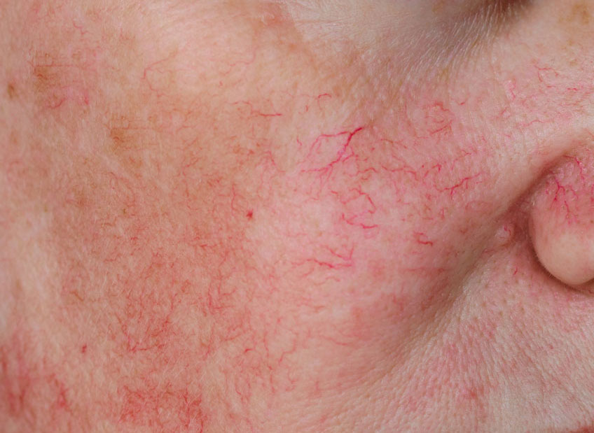 Broken Capillaries