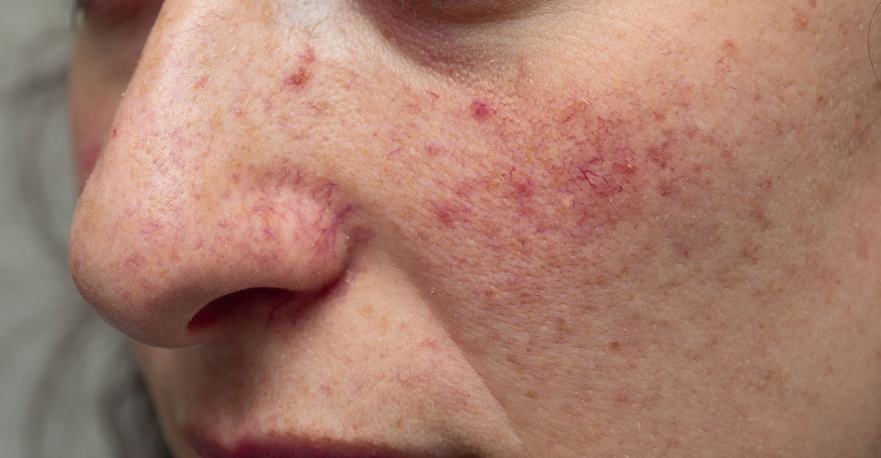Broken Capillaries