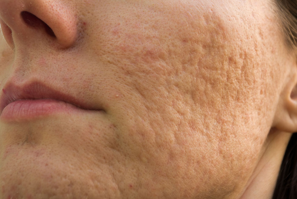 Cheek with acne scars
