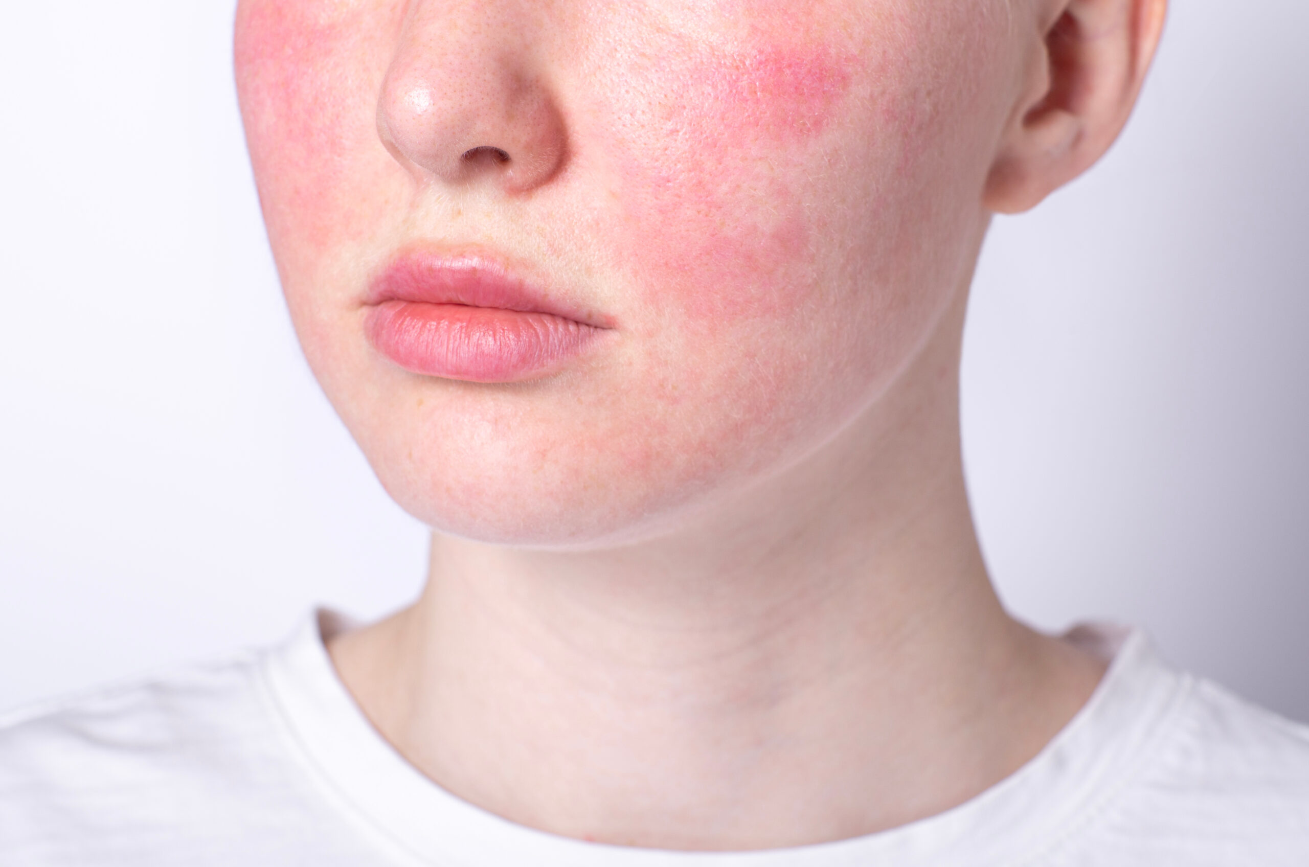 Skin Redness on Female