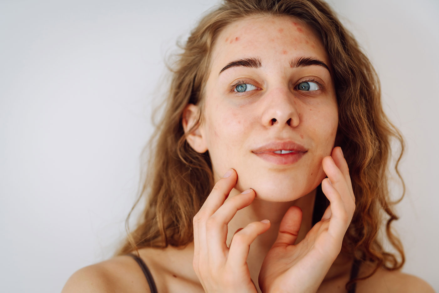 Young woman with pigmentation