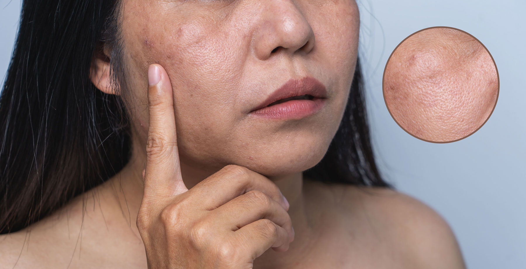 Circle showing larger Pores