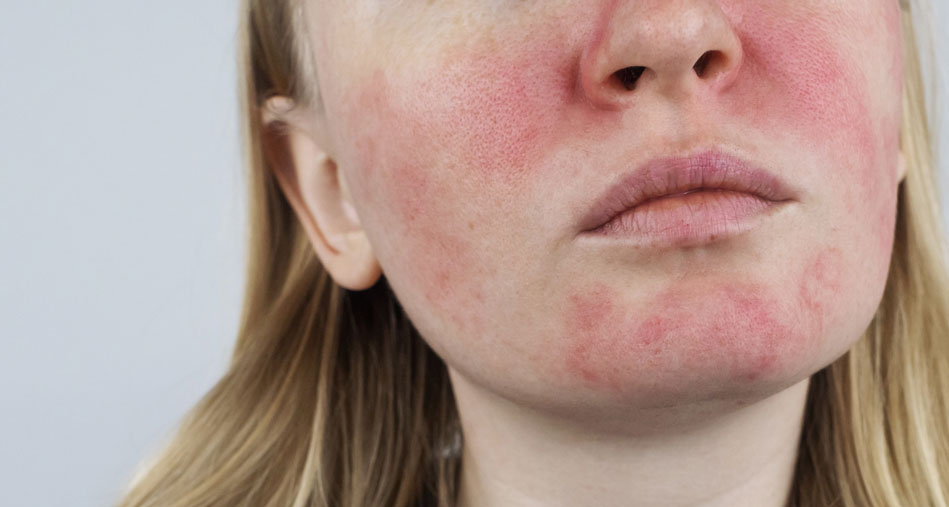 Rosacea-whole-face
