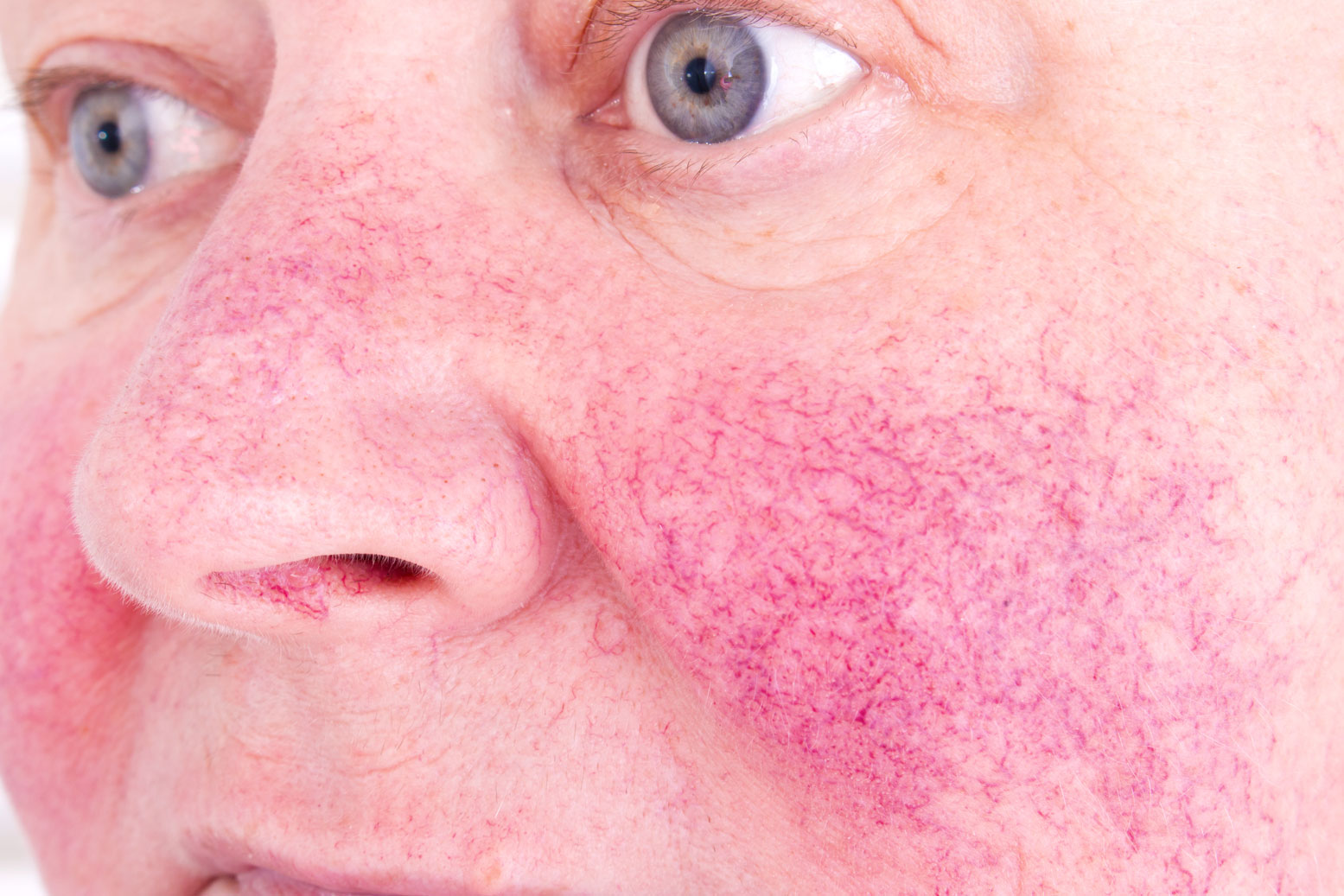 Rosacea cheek