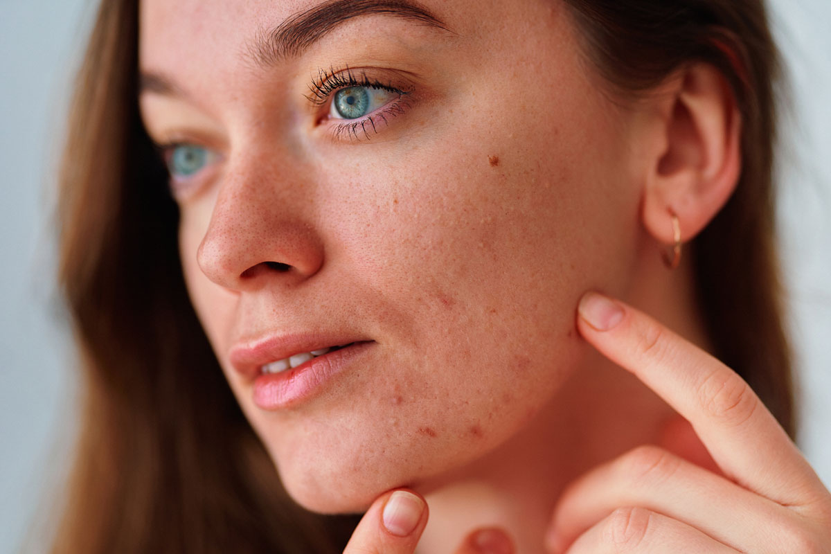 Girl pointing at acne
