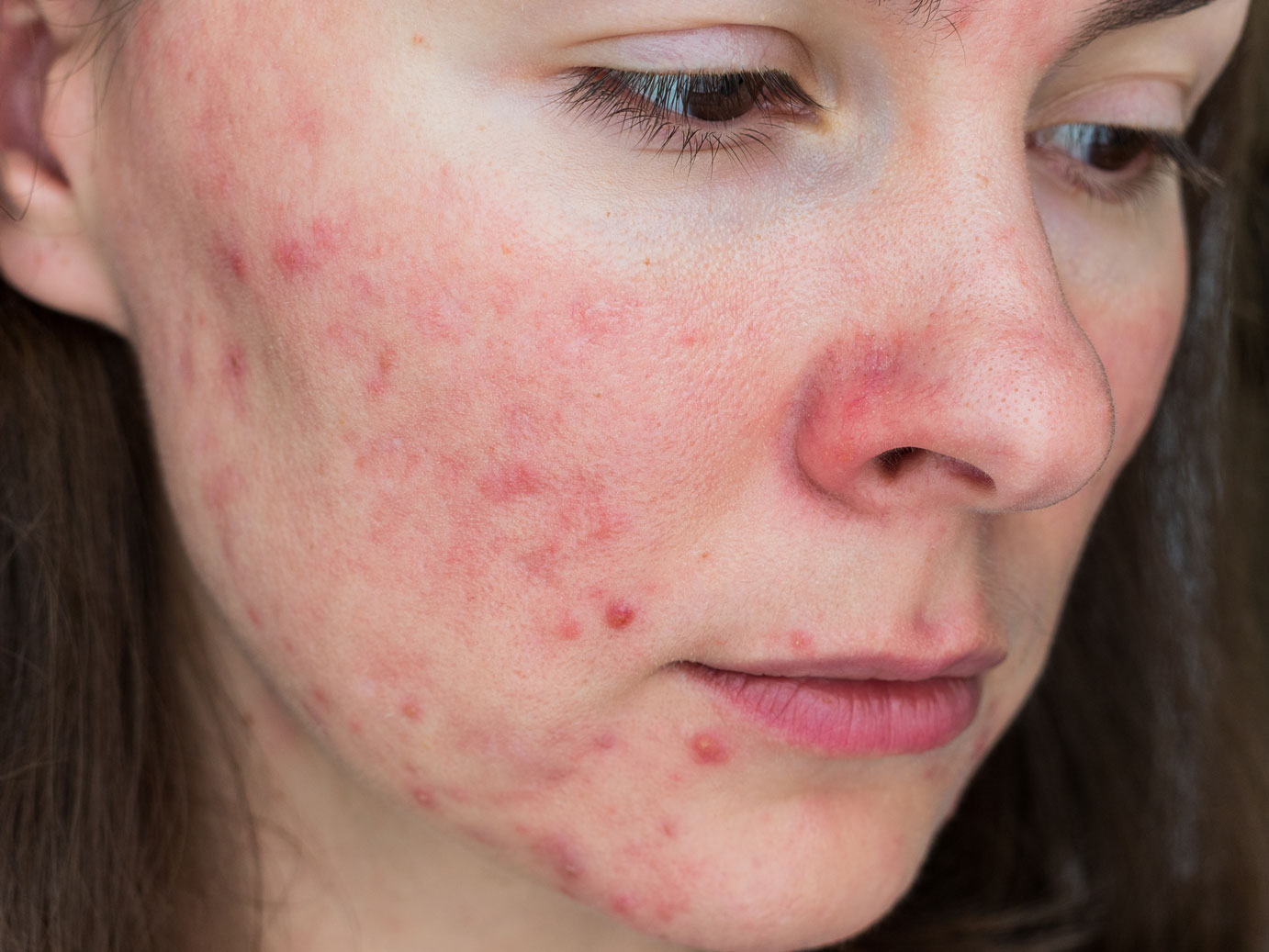 Acne on girl