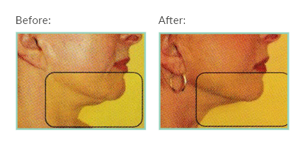 iNeedle before and after