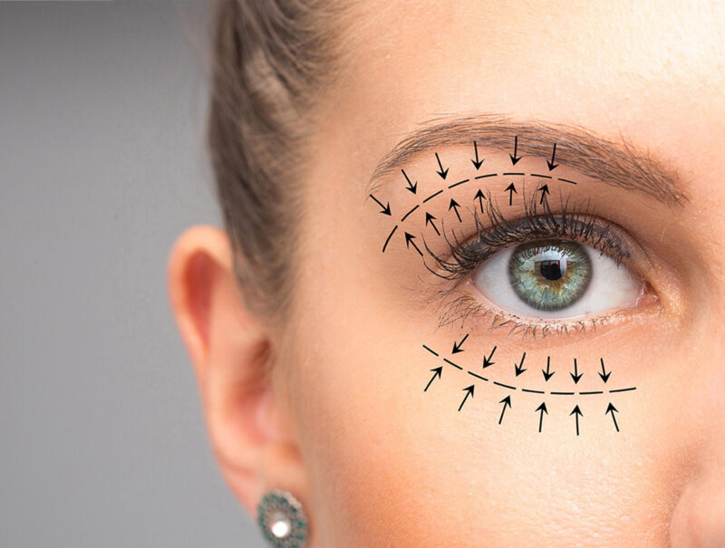 Blepharoplasty eyelid surgery, cosmetic facial surgery newcastle and maitland.