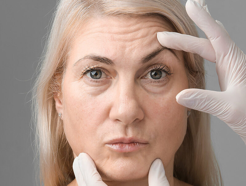 Browlift, Forehead lift cosmetic facial surgery, Newcastle and Maitland