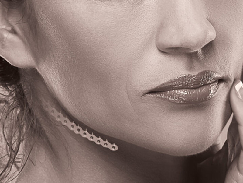 Endotine-ribbon-lifting-for-neckline-800x600 Ribbon Lift for lower jawline treatment, preface cosmetic, newcastle