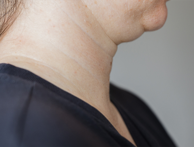 Chin Lift Surgery Newcastle and Maitland